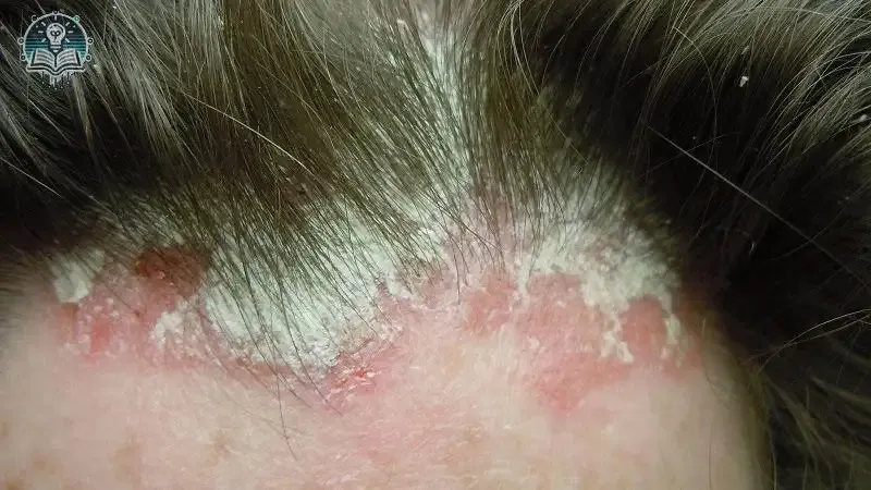 tác hại do nấm da 6