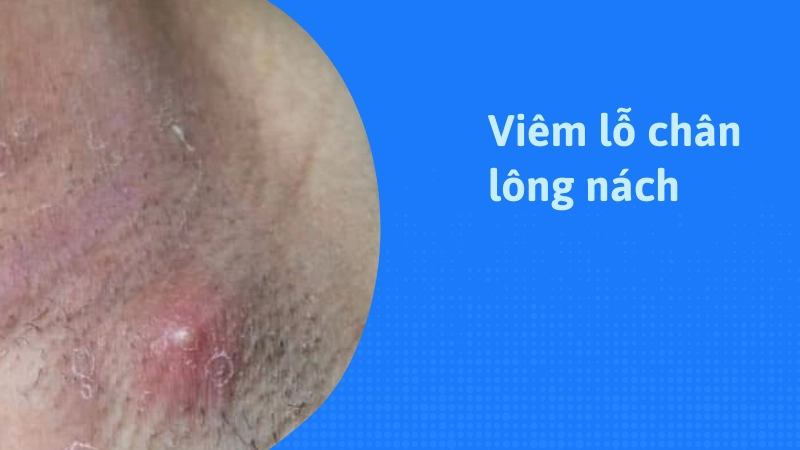 Viêm lỗ chân lông vì tác hại của việc nhổ lông nách